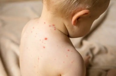 baby-skin-rash